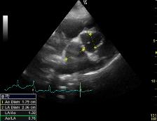 Hjärtultraljud med EKG